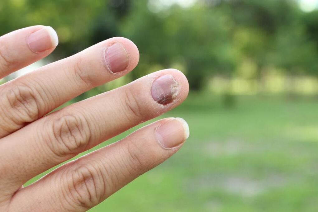 grzyb paznokci